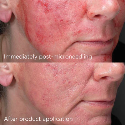 IMAGE Skincare DAILY PREVENTION Advanced Smartblend Mineral Moisturiser SPF 50+ visible redness immediately after microneedling and after application