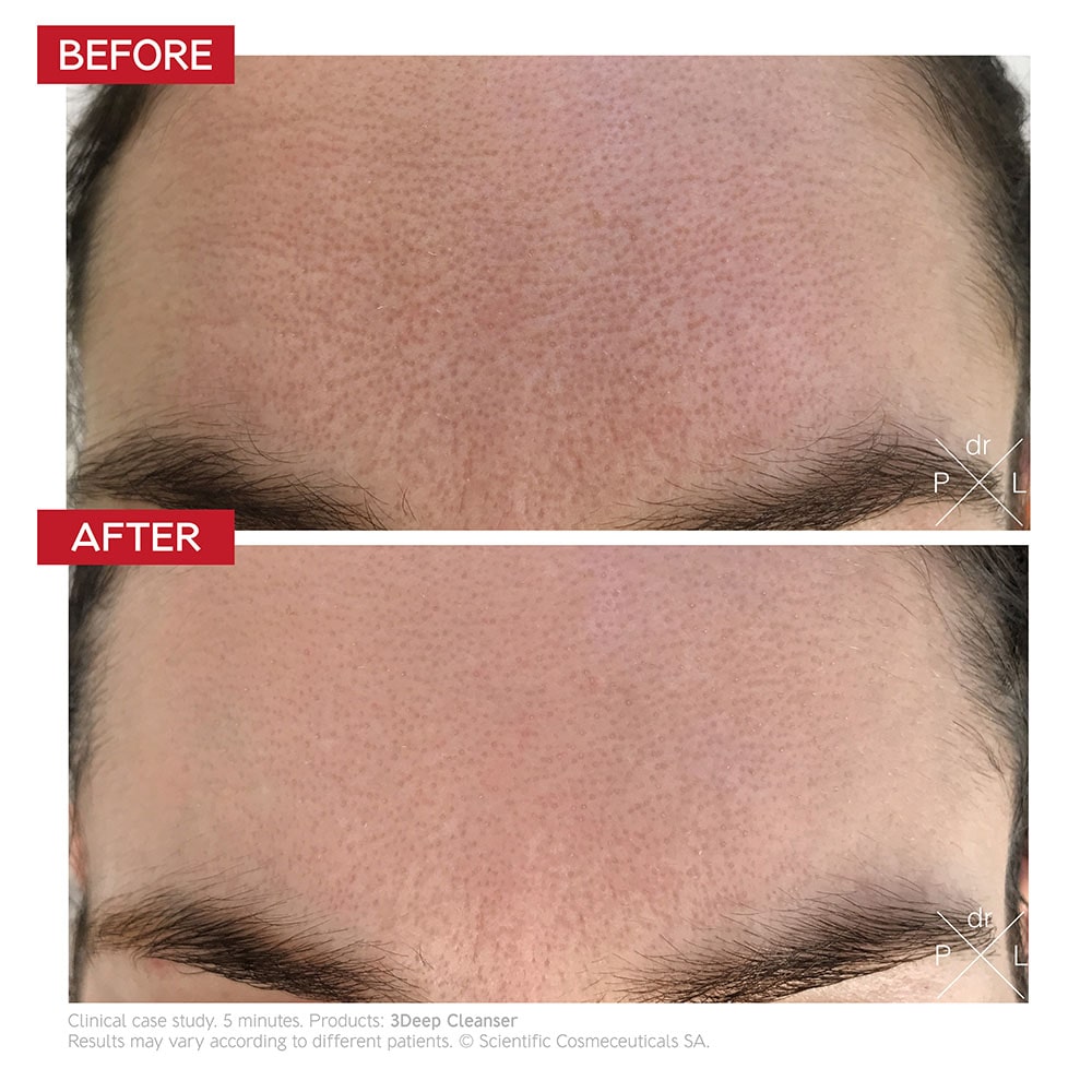 Dr LEVY 3Deep Cell Renewal Micro-Resurfacing Cleanser before and after results
