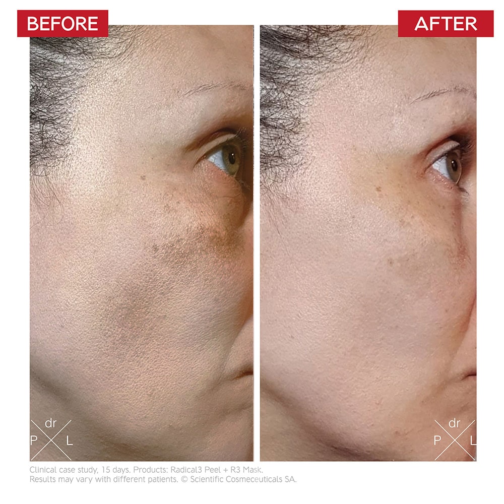 Dr LEVY Radical3 Reboot Pro Peel before and after results
