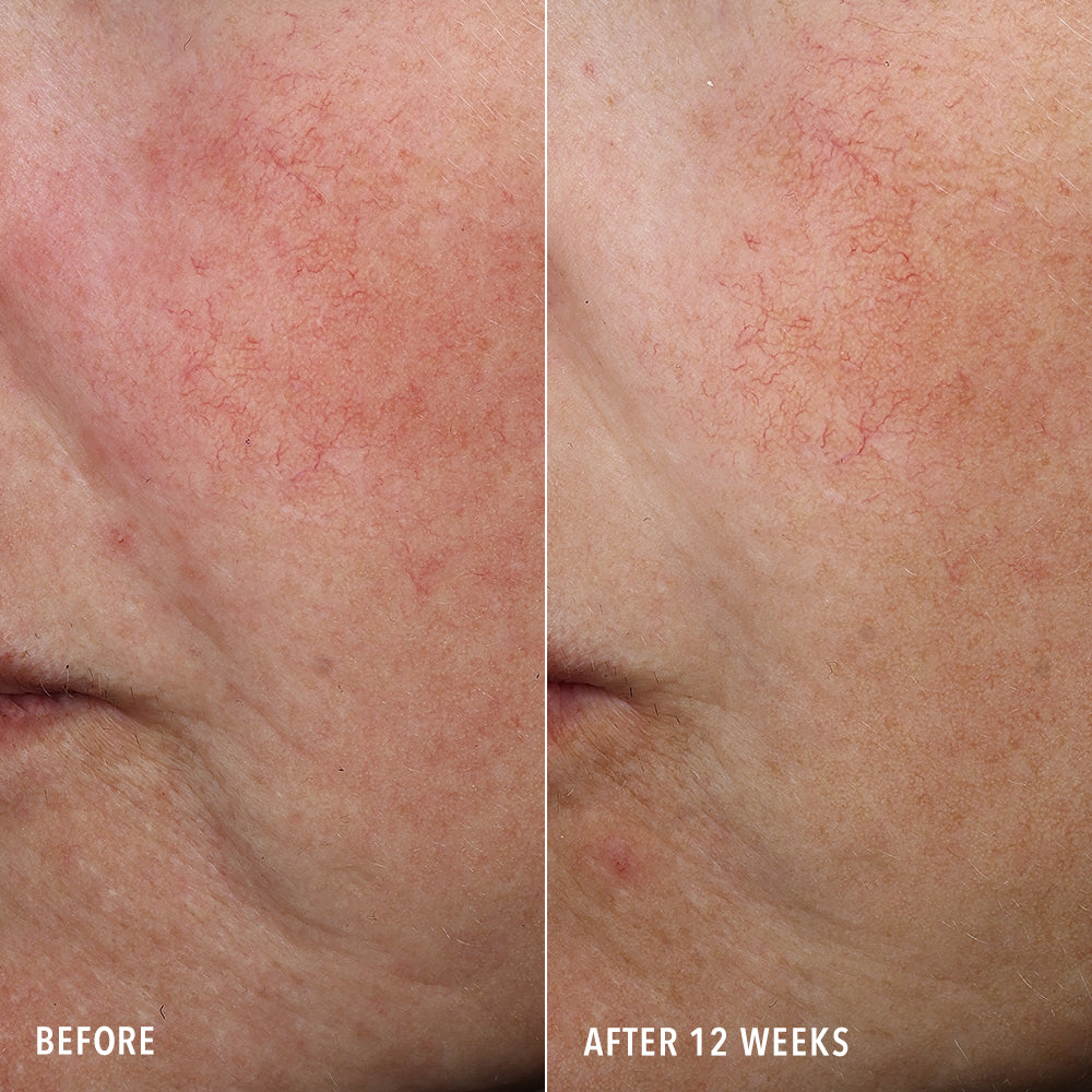 HydroPeptide Syner-C+ before and after results