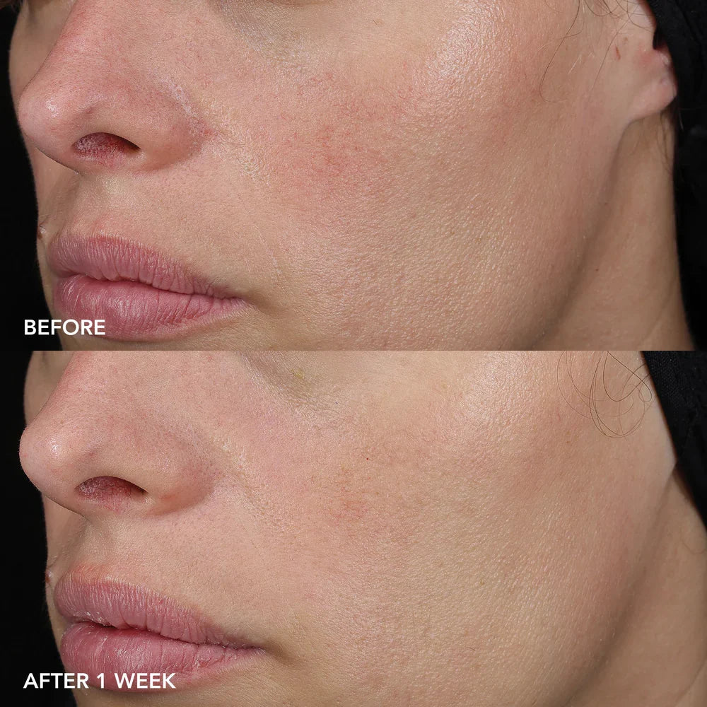 IMAGE Skincare MD Barrier Repair Recovery Balm before and after one week of use