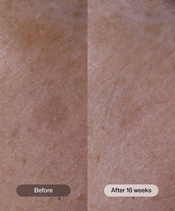 Revision Skincare Advanced Pigment Corrector+ before and after showing more even-looking skin tone