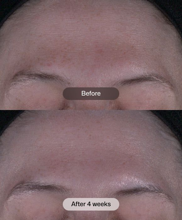 Revision Skincare Tone+ Correcting Pads before and after showing smoother, more even-looking skin