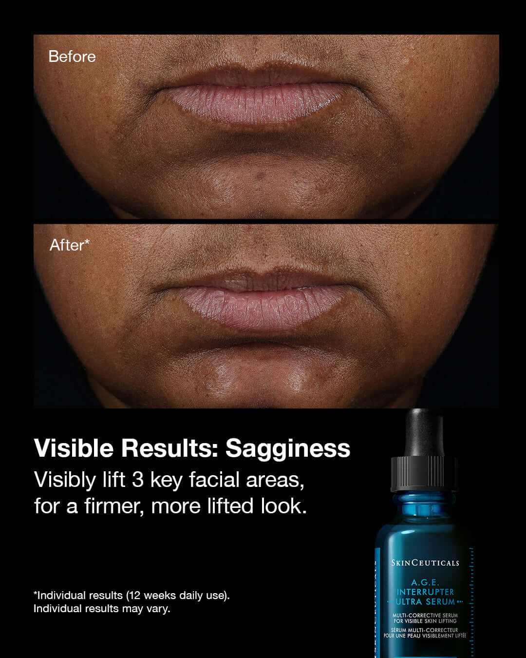 Before and after results using SkinCeuticals A.G.E. Interrupter Ultra Serum showing improved firmness and lift.
