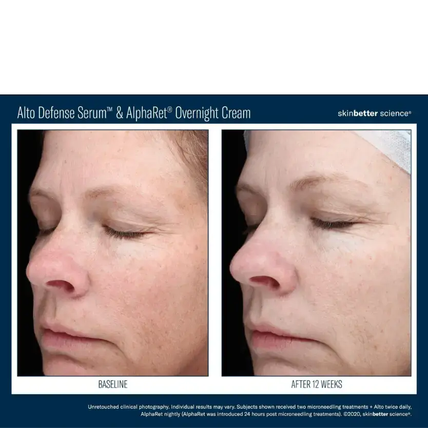 Before and after results of SkinBetter Science A-Team Duo Advanced Kit showcasing skin transformation after 12 weeks.