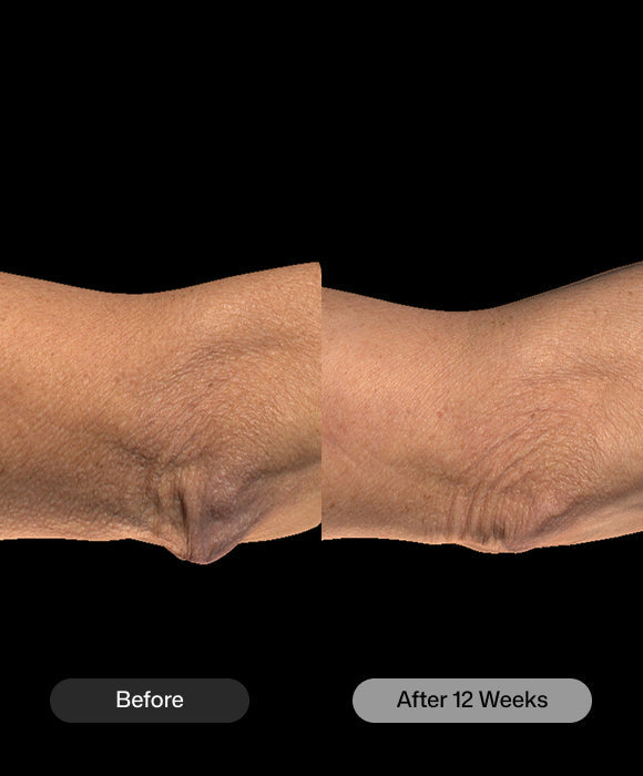 Revision Skincare BodiContour before and after 12 weeks