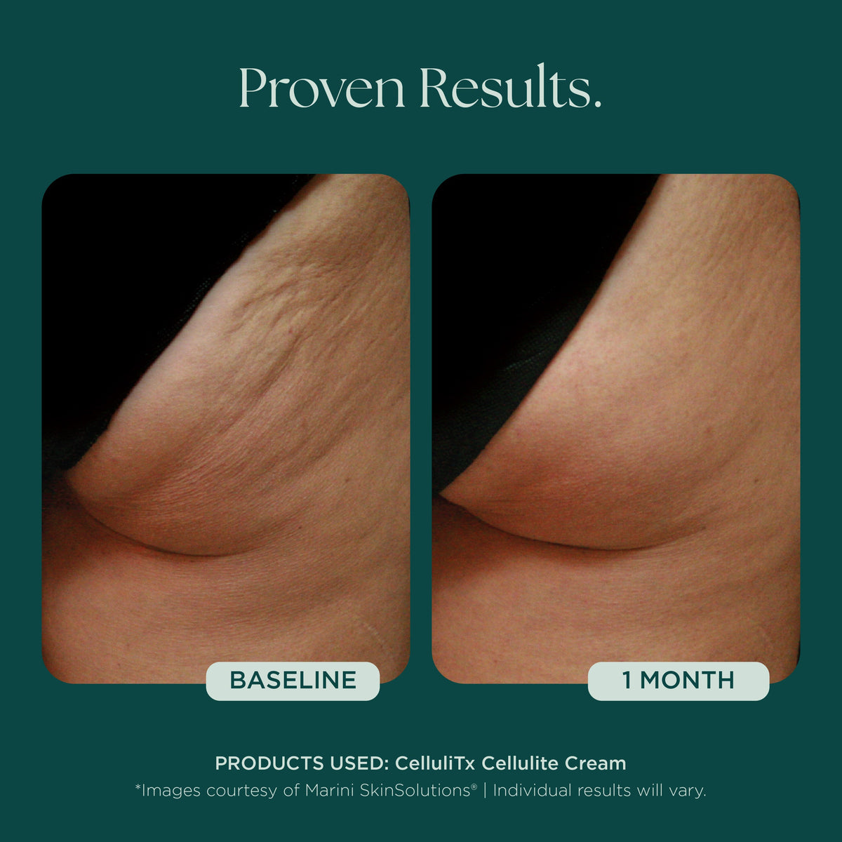 Marini SkinSolutions CelluliTx Cellulite Cream - before and after, thighs