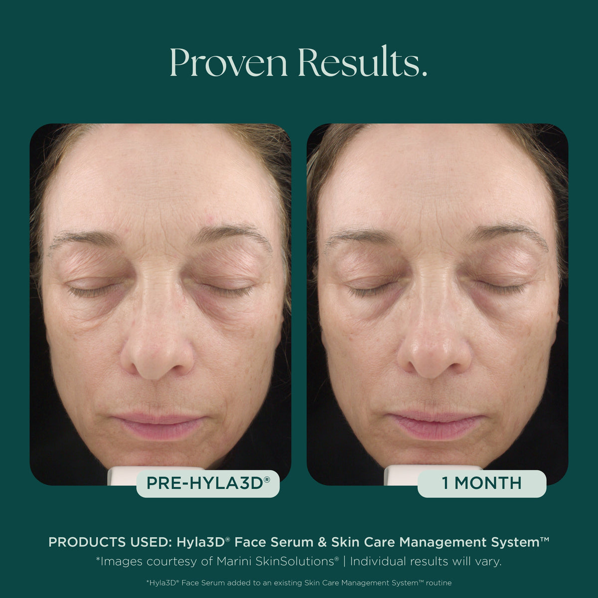 Marini SkinSolutions Hyla3D Face Serum - before and after, skin volume