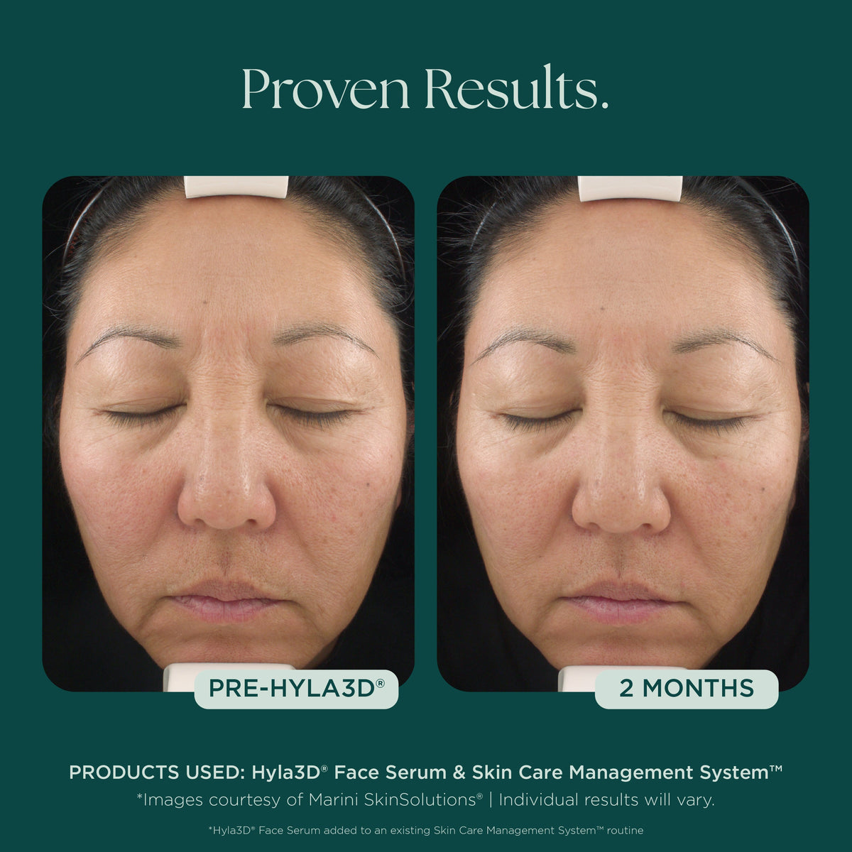 Marini SkinSolutions Hyla3D Face Serum - before and after, skin bounce