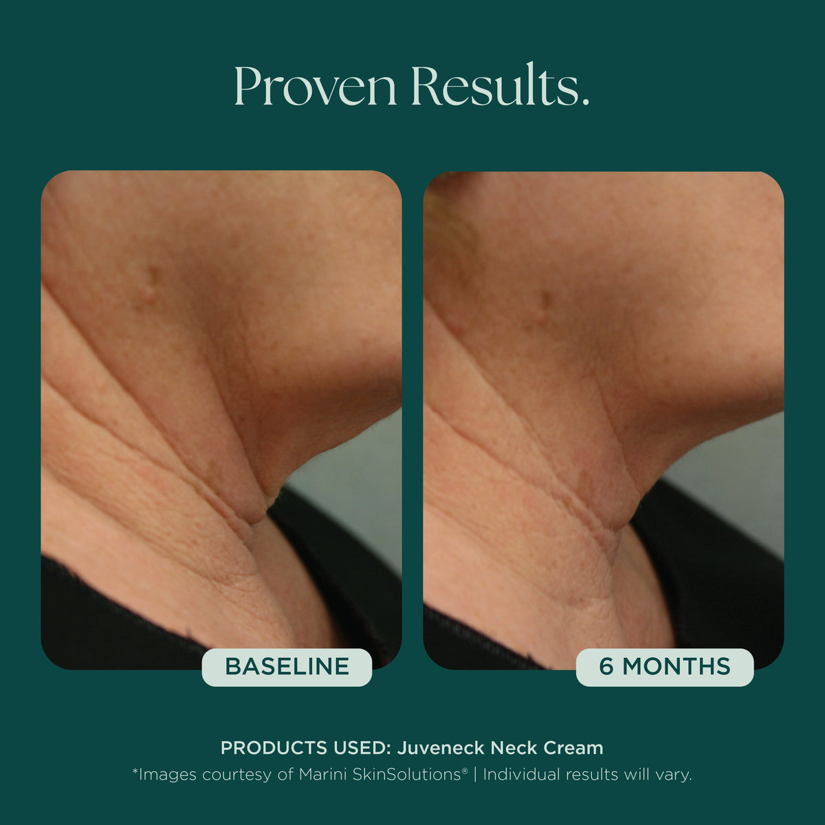 Marini SkinSolutions Juveneck - before and after, neck lines