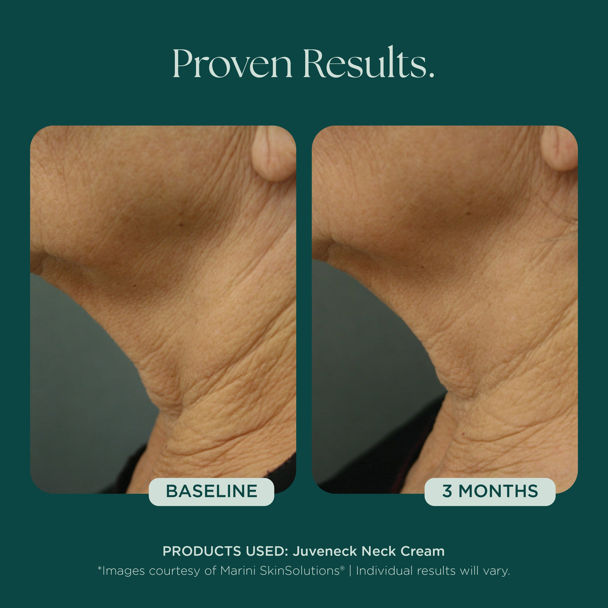 Marini SkinSolutions Juveneck - before and after, neck texture
