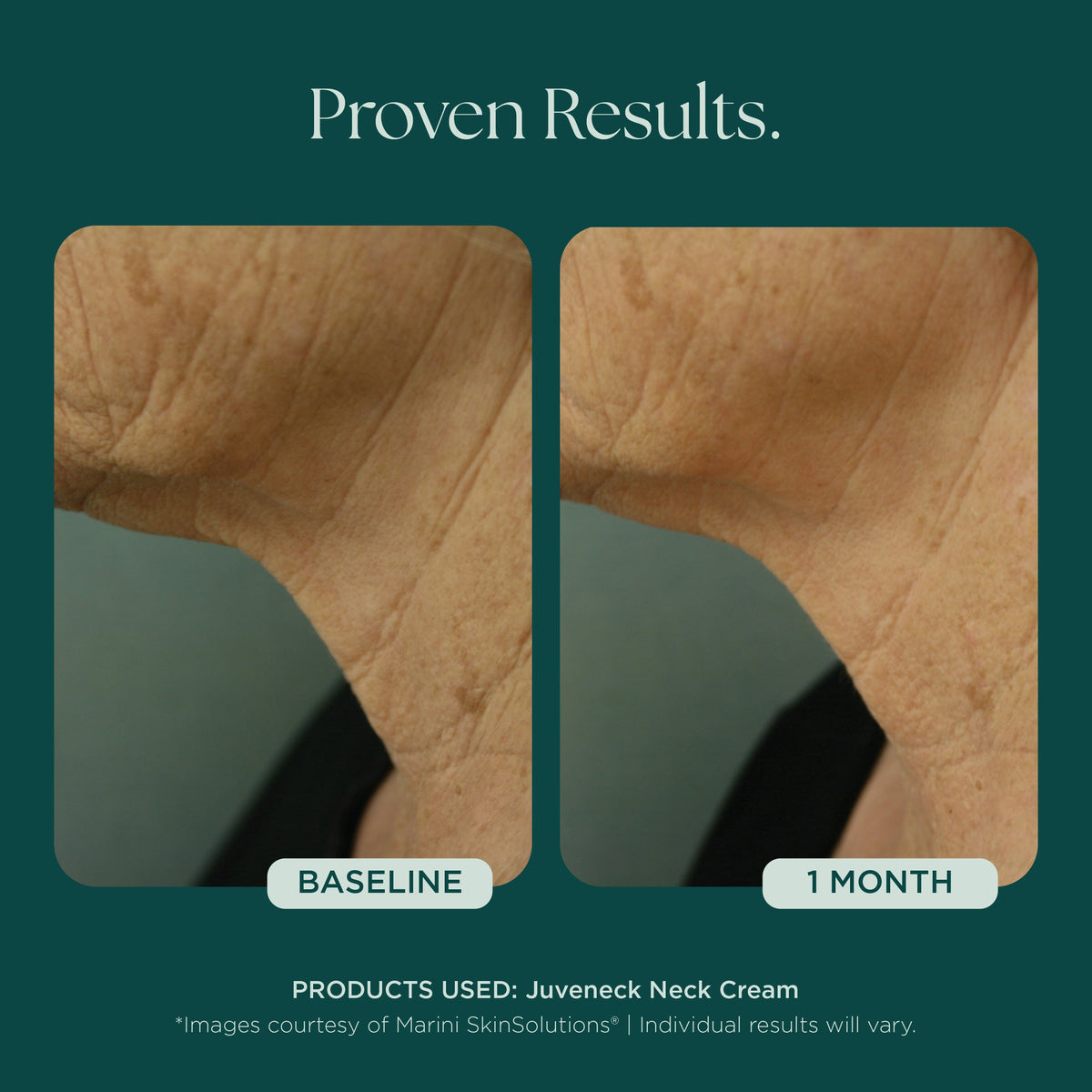 Marini SkinSolutions Juveneck - before and after, firmness