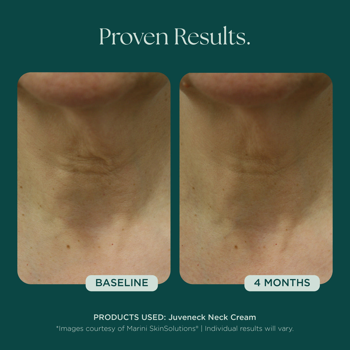 Marini SkinSolutions Juveneck - before and after, decollete