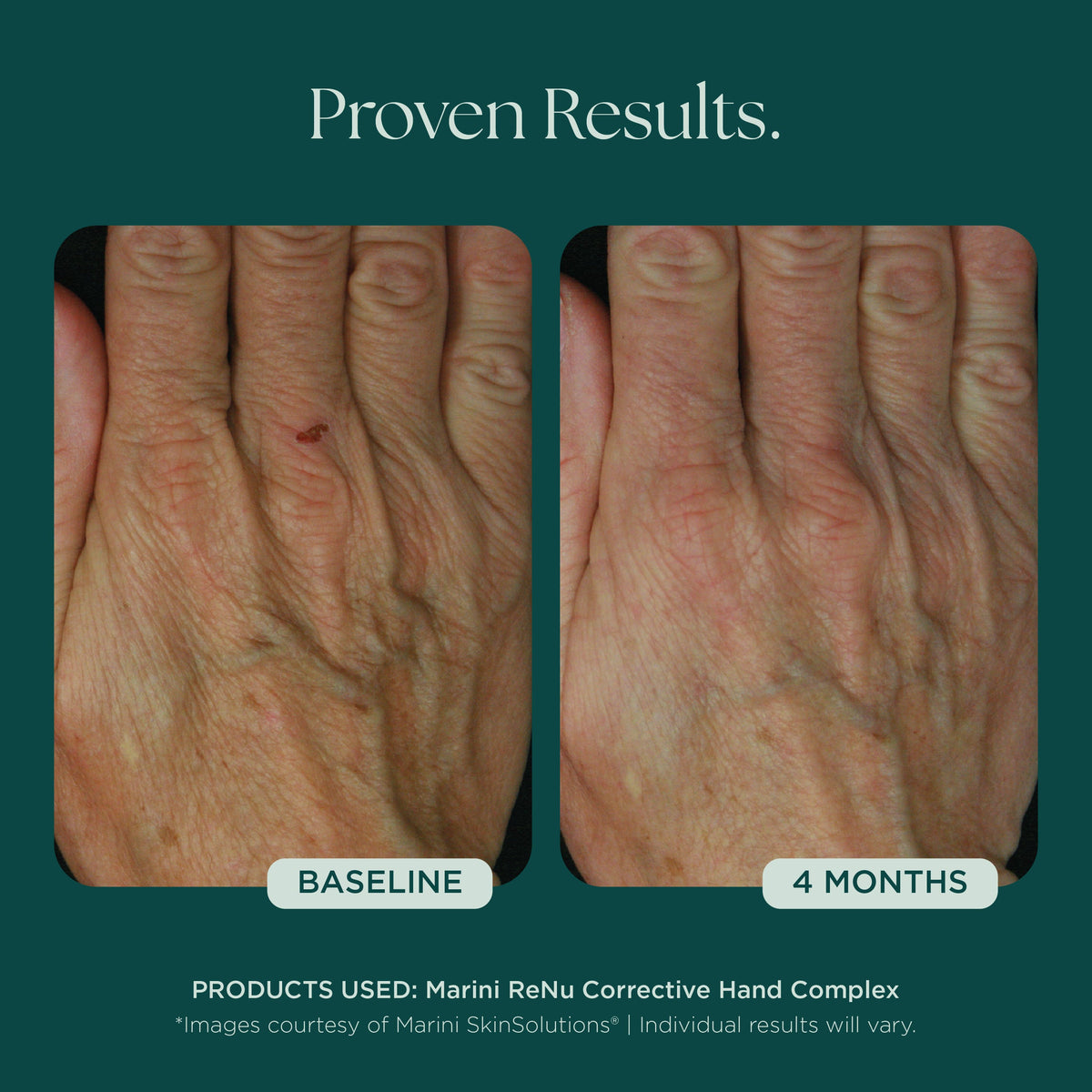 Marini SkinSolutions ReNu Corrective Hand Complex - before and after, hand texture
