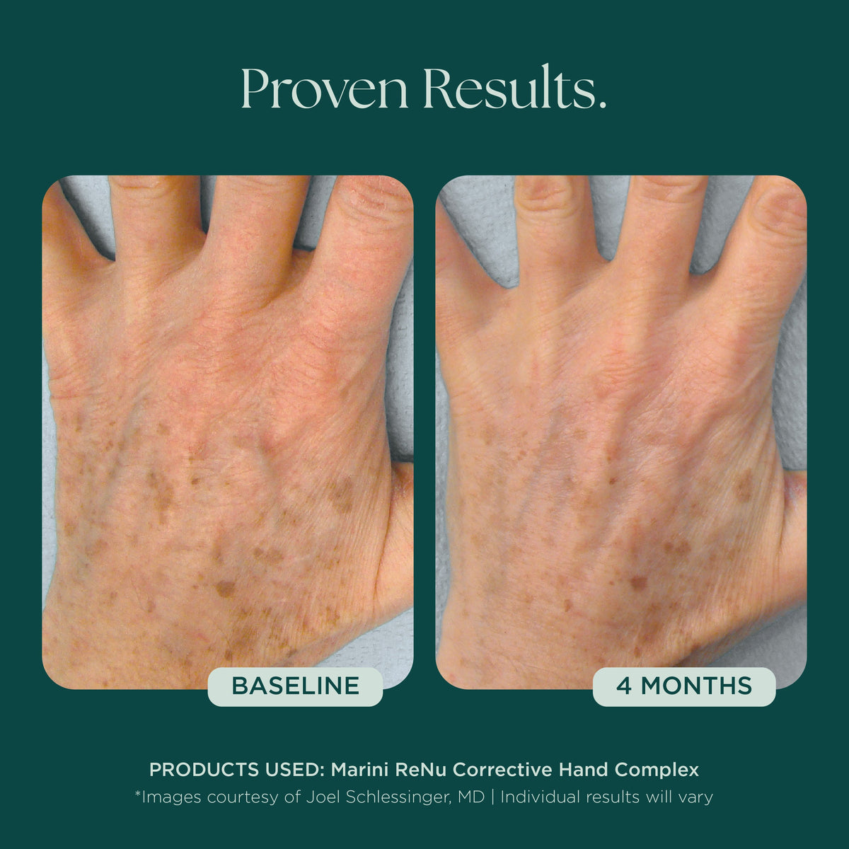 Marini SkinSolutions ReNu Corrective Hand Complex - before and after, dark spots