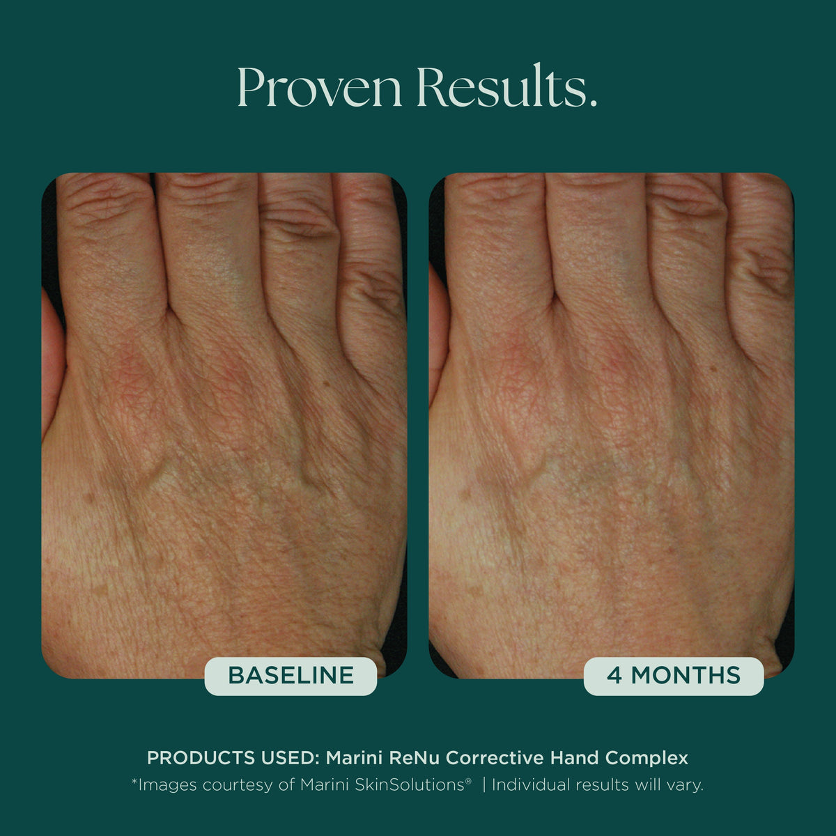 Marini SkinSolutions ReNu Corrective Hand Complex - before and after, even tone