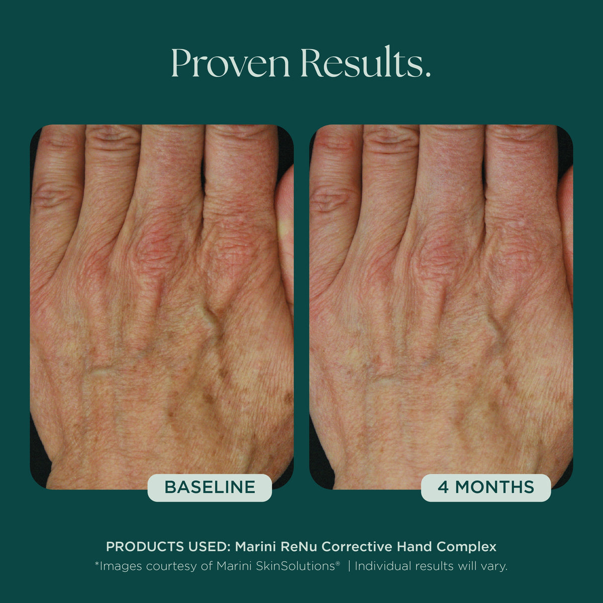 Marini SkinSolutions ReNu Corrective Hand Complex - before and after, fine lines