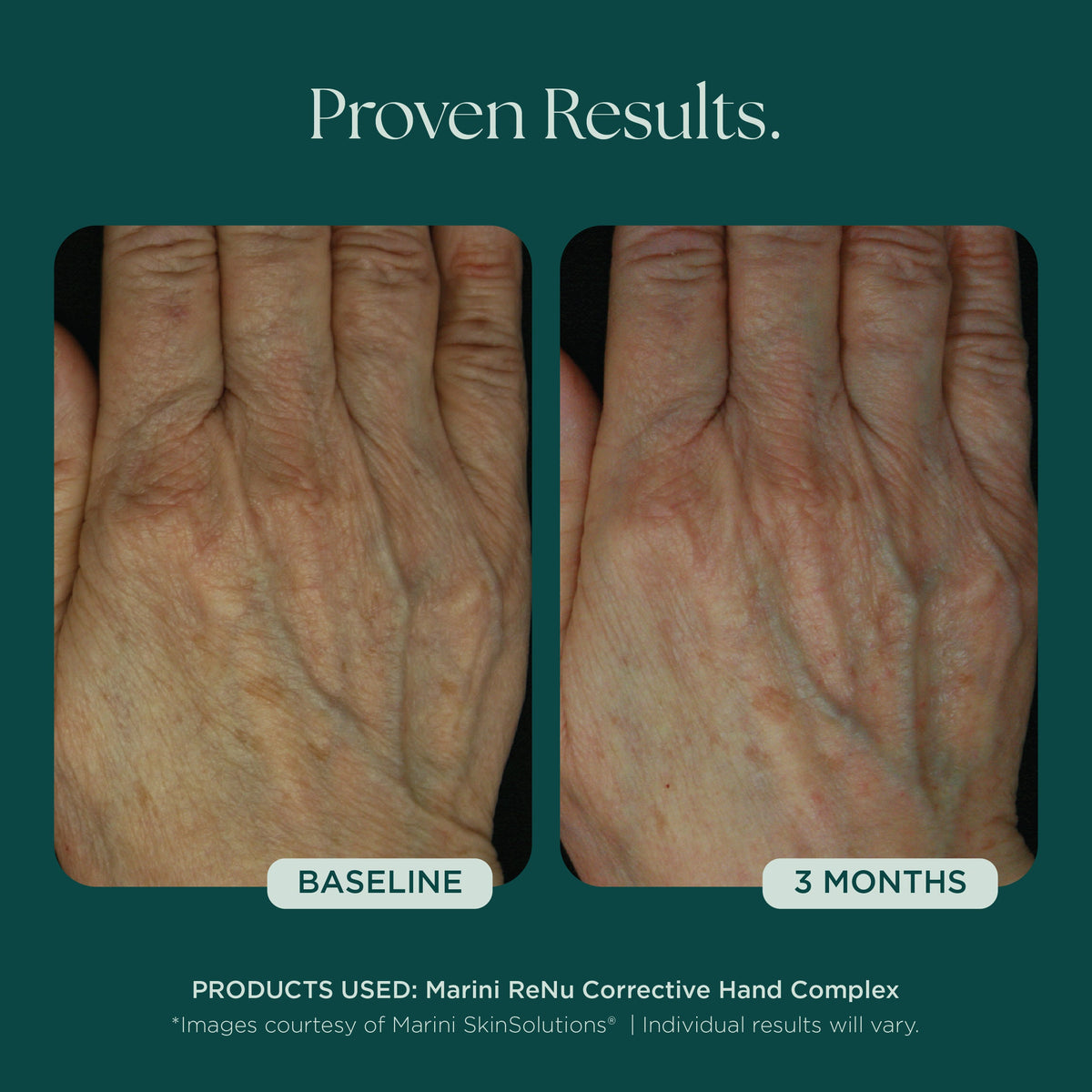 Marini SkinSolutions ReNu Corrective Hand Complex - before and after, brighter hands
