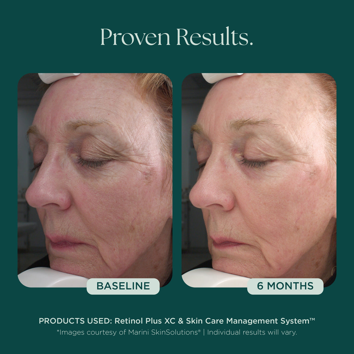 Marini SkinSolutions Retinol Plus XC - before and after, fine lines