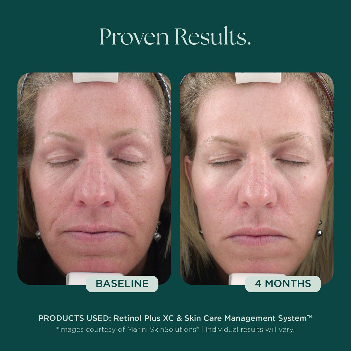 Marini SkinSolutions Retinol Plus XC - before and after, wrinkles