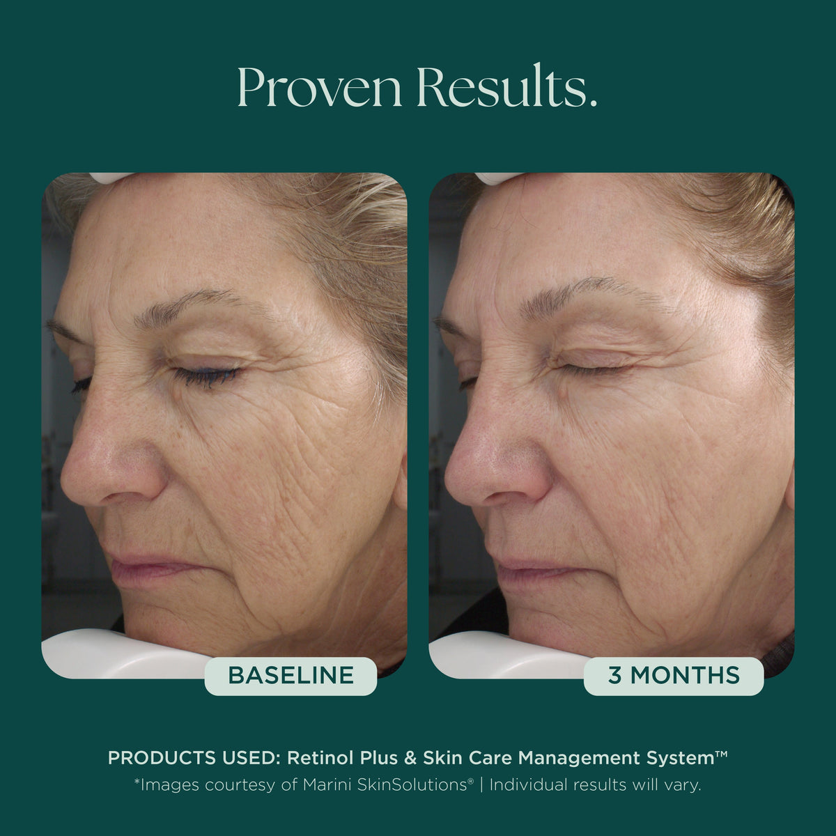 Marini SkinSolutions Retinol Plus XC - before and after, texture
