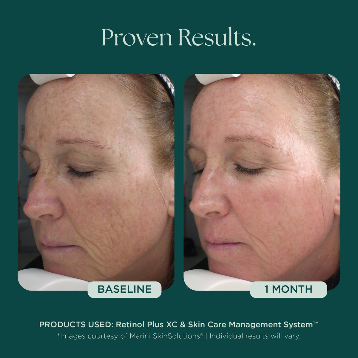 Marini SkinSolutions Retinol Plus XC - before and after, smoother skin