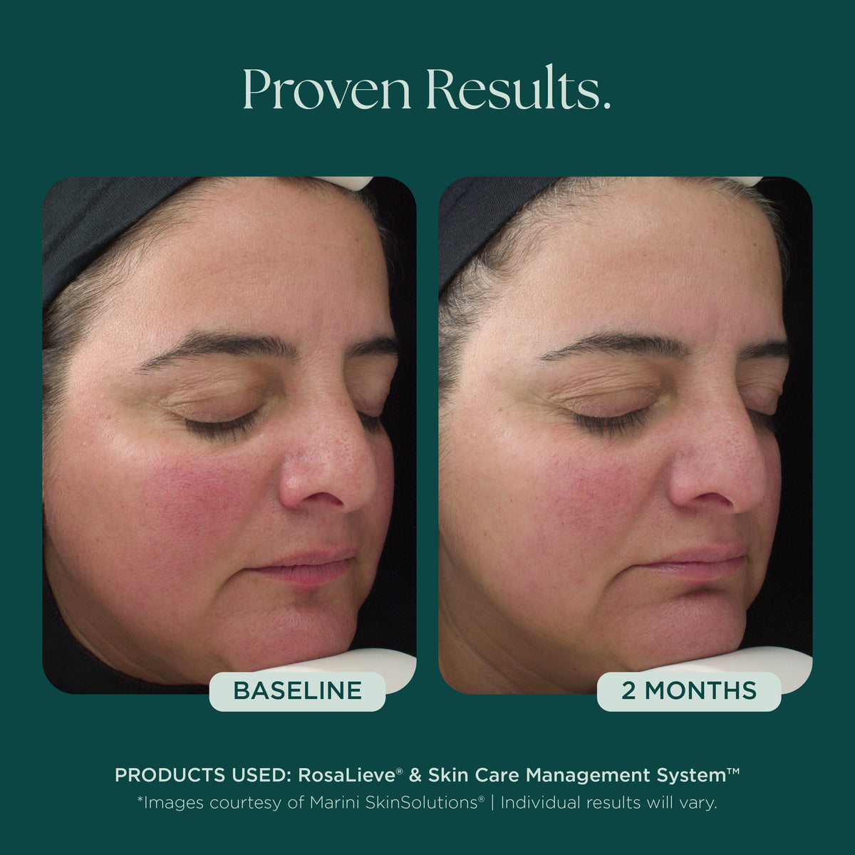 Marini SkinSolutions RosaLieve - before and after, visible redness