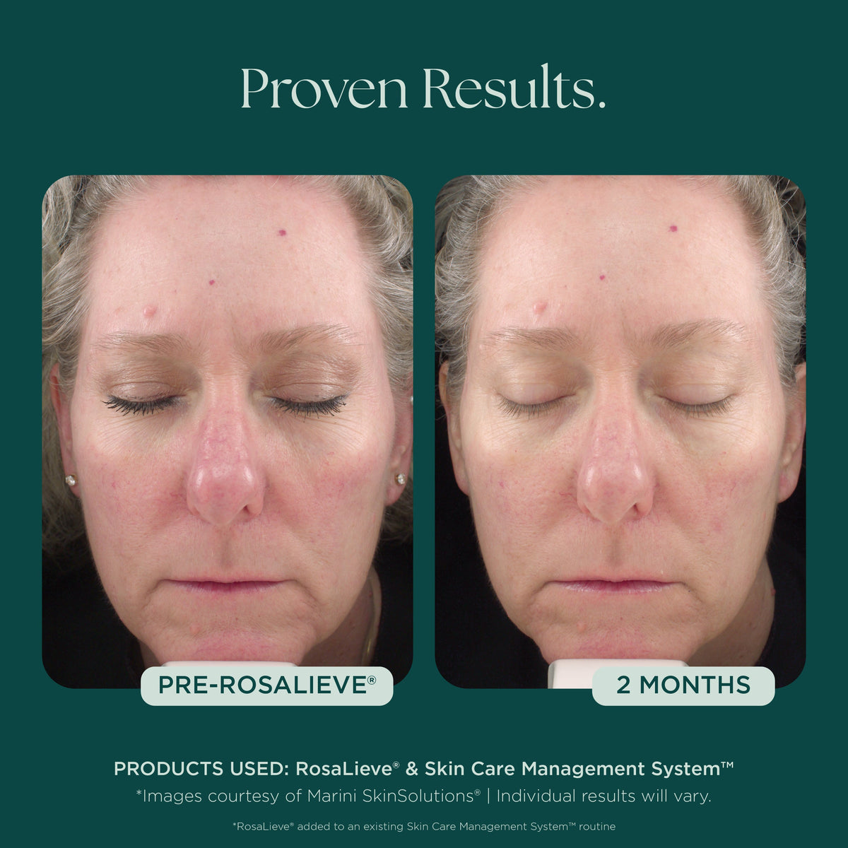 Marini SkinSolutions RosaLieve - before and after, cheeks