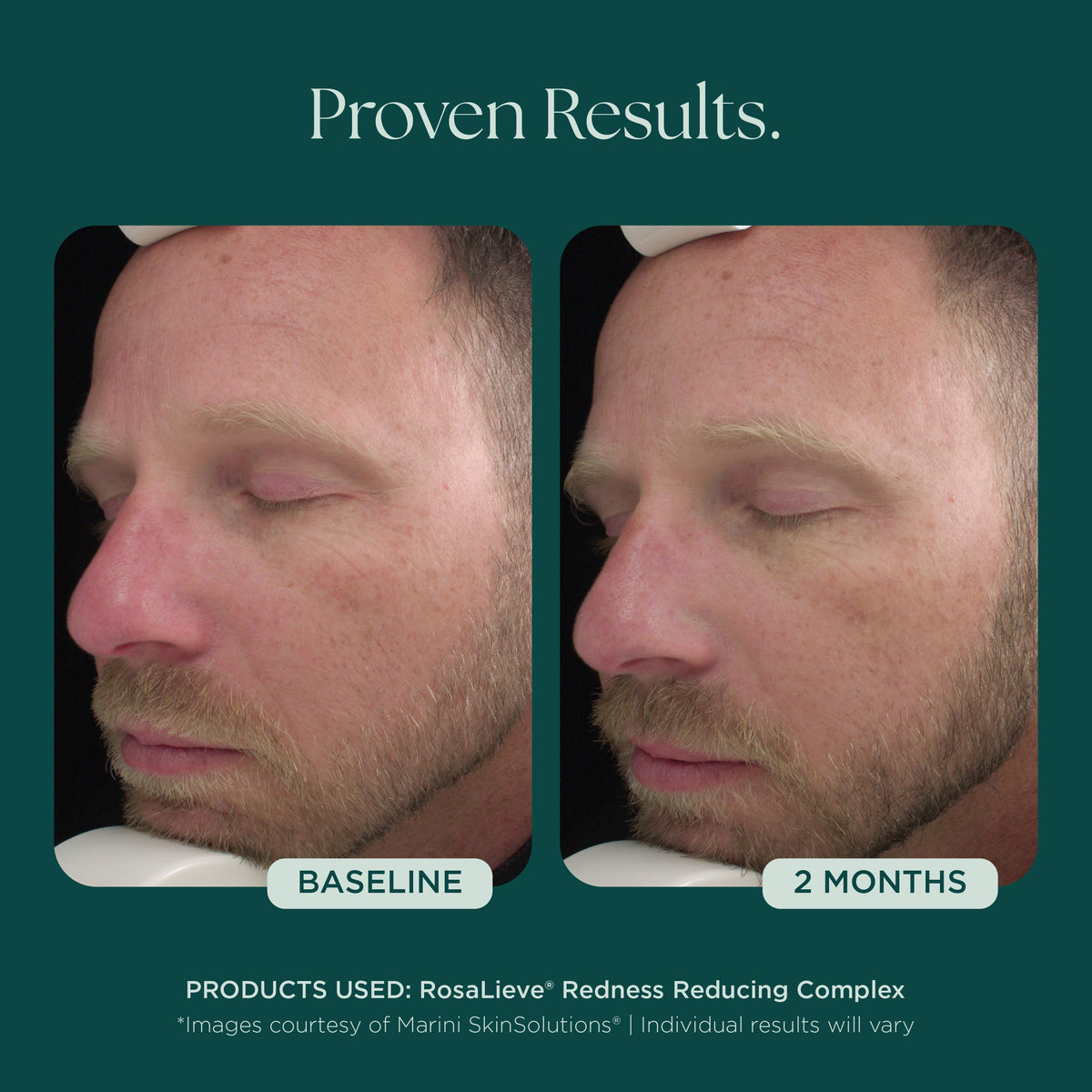 Marini SkinSolutions RosaLieve - before and after, even tone