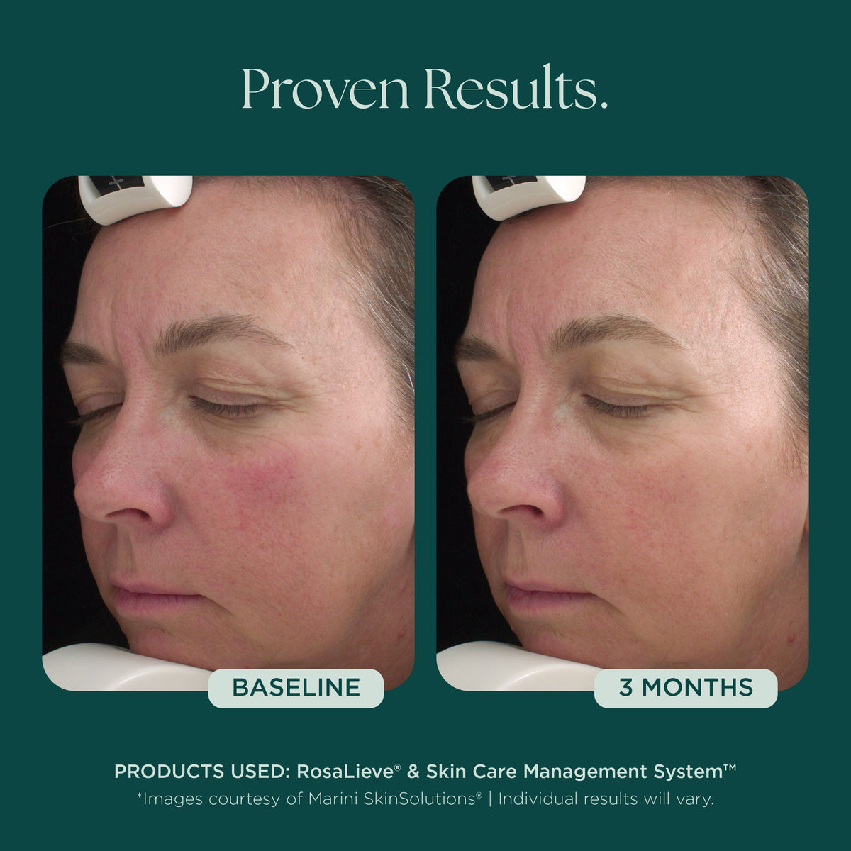 Marini SkinSolutions RosaLieve - before and after, calmer skin
