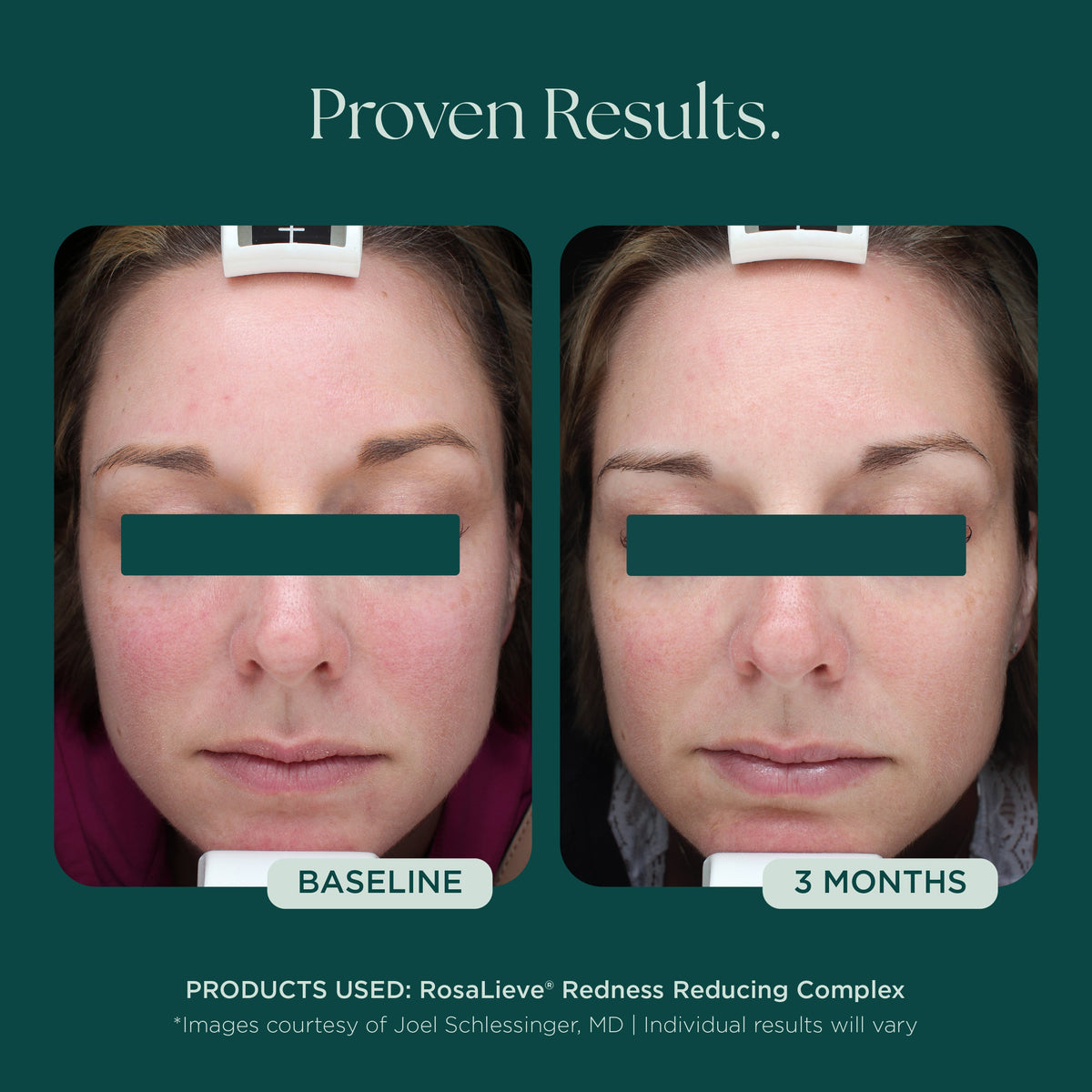 Marini SkinSolutions RosaLieve - before and after, flushing