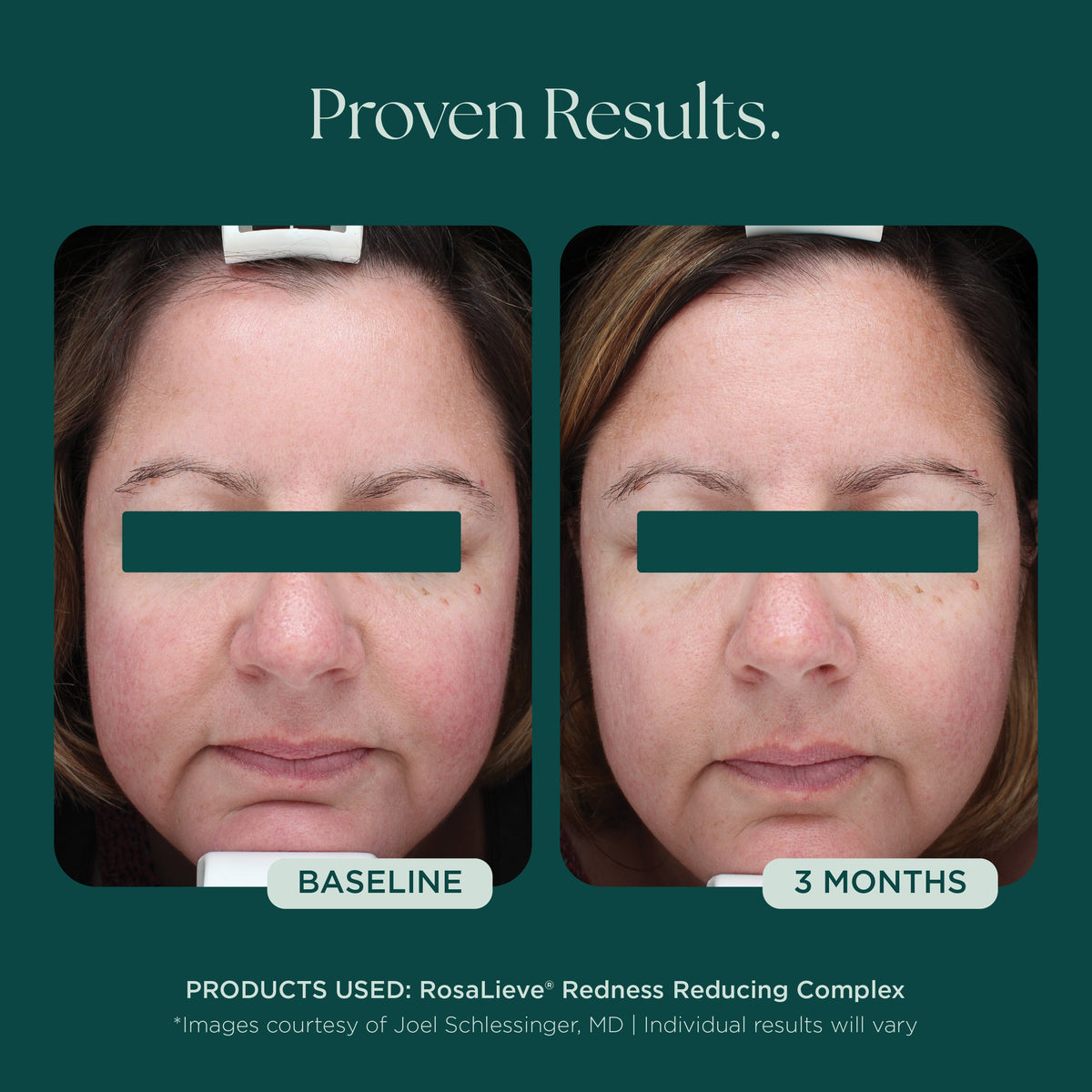 Marini SkinSolutions RosaLieve - before and after, complexion