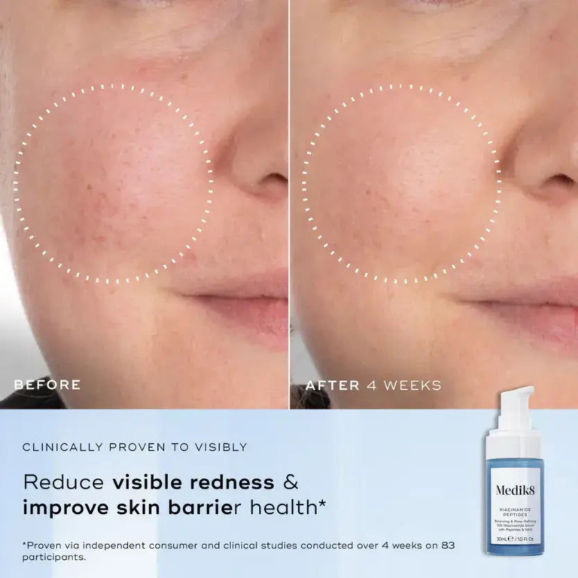 Before and after results showing Medik8™ Niacinamide Peptides reducing visible redness and improving skin health.